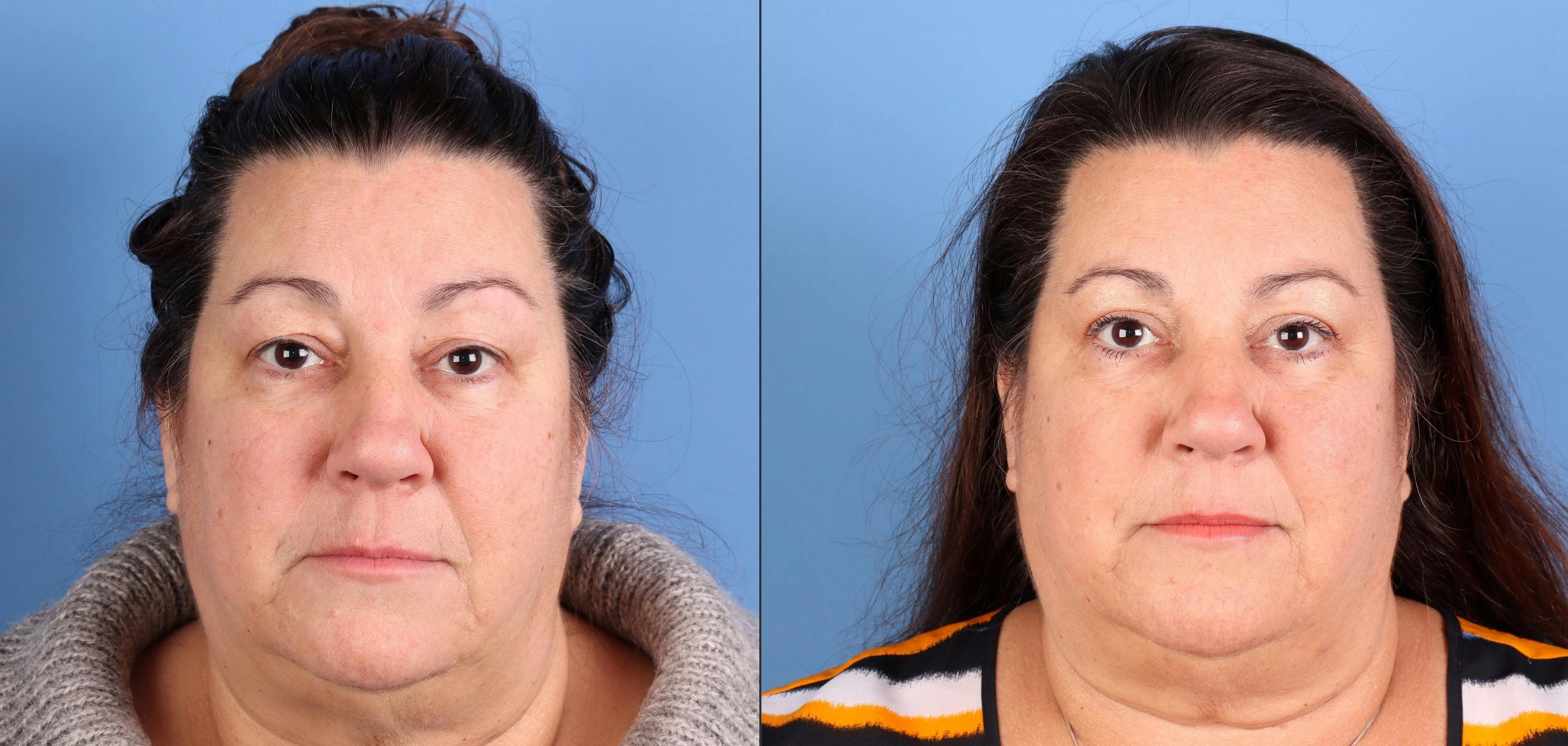 Eyelid Surgery (Upper Blepharoplasty) Before & After Gallery - Patient 185689 - Image 1