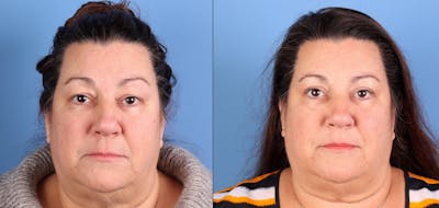 Eyelid Surgery (Upper Blepharoplasty) Before & After Gallery - Patient 185689 - Image 1