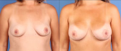 Breast Augmentation Before & After Gallery - Patient 201164 - Image 1