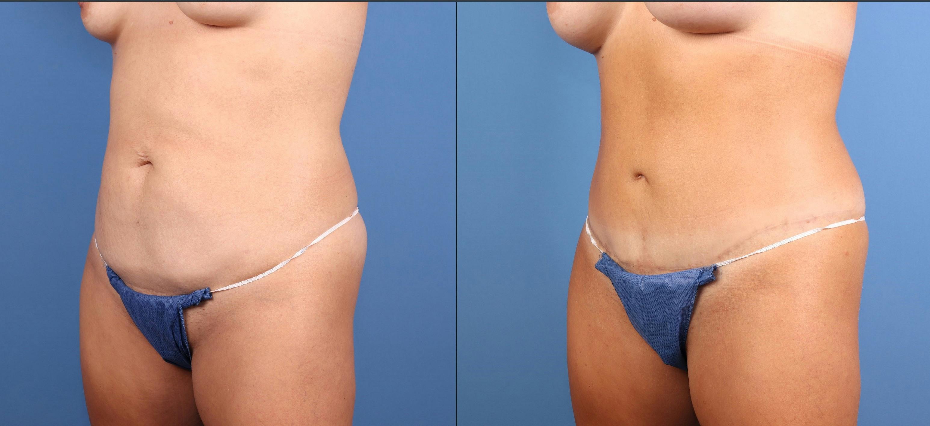 Mommy Makeover Before & After Gallery - Patient 397371 - Image 2