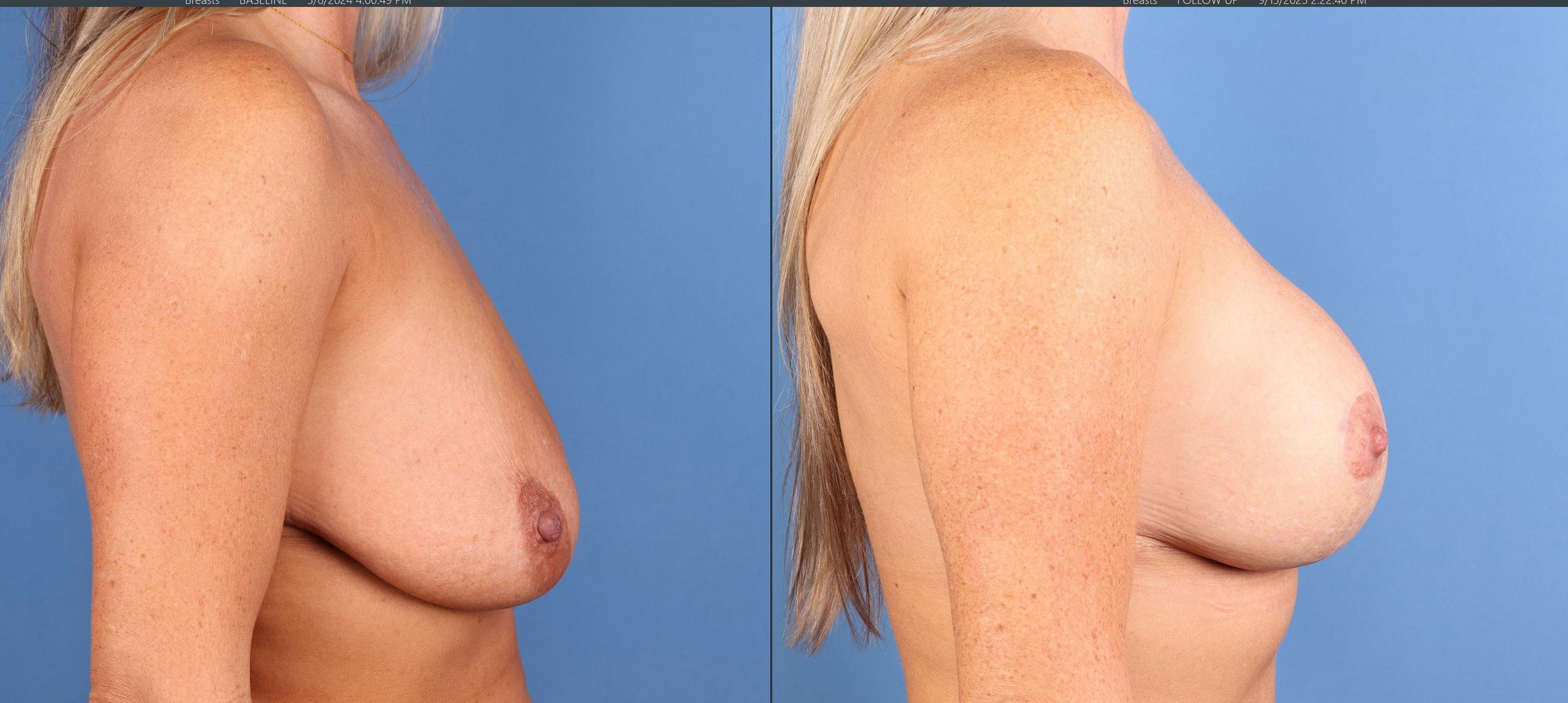 Breast Lift with Augmentation Before & After Gallery - Patient 301859 - Image 3