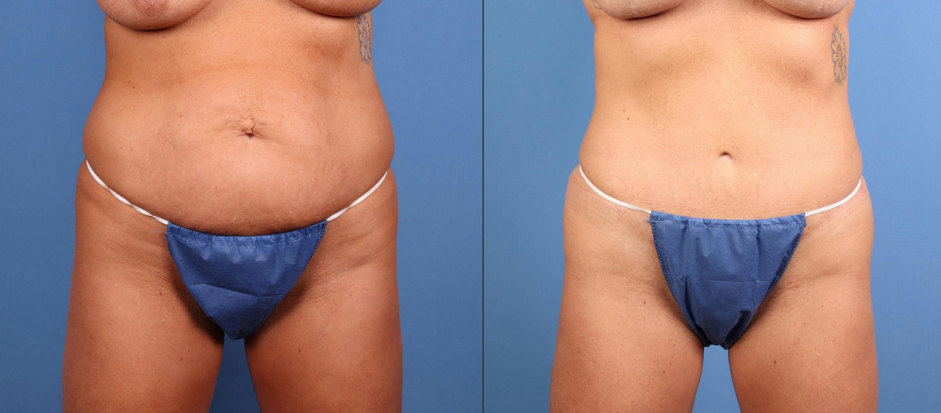 Tummy Tuck Before & After Gallery - Patient 317065 - Image 2
