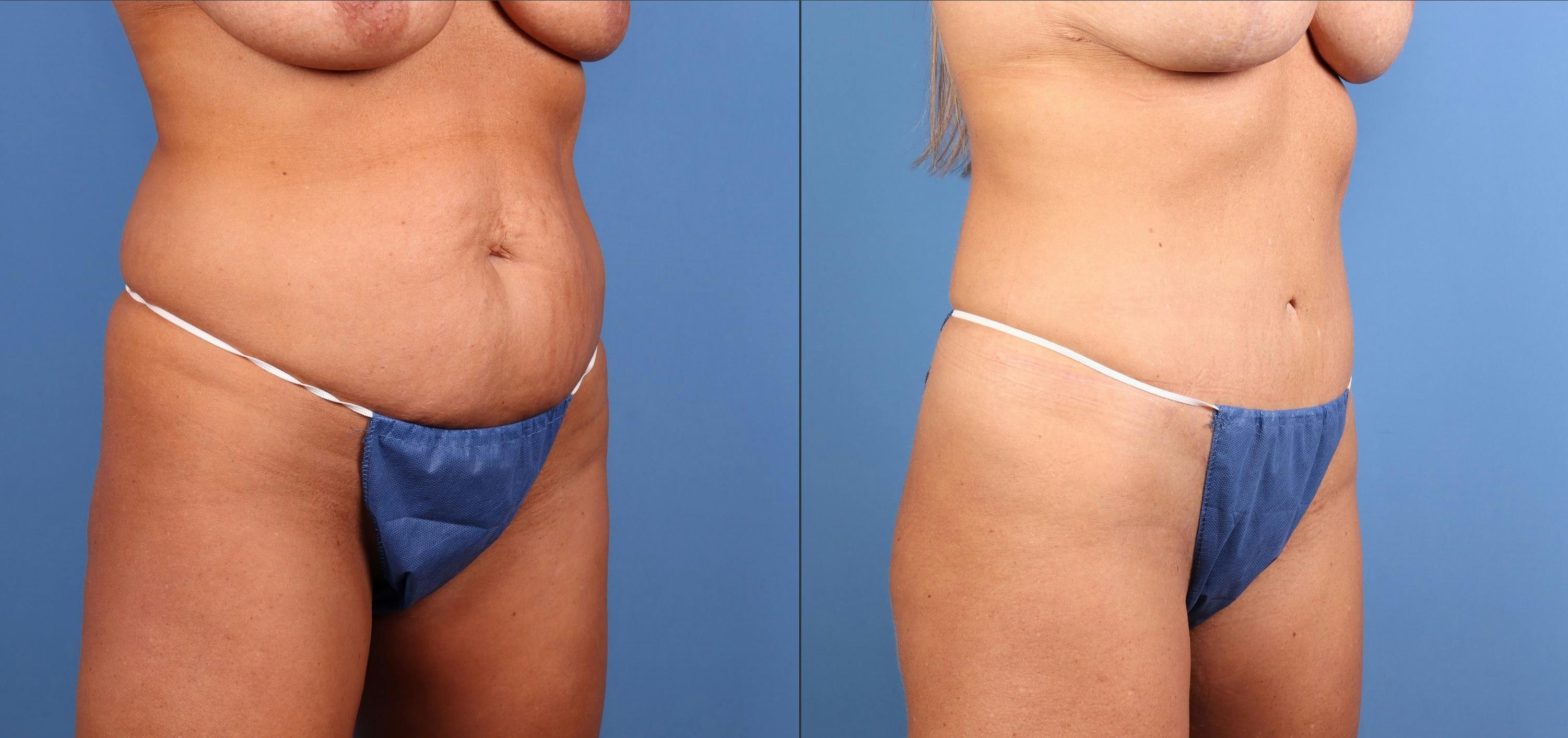 Tummy Tuck Before & After Gallery - Patient 317065 - Image 3
