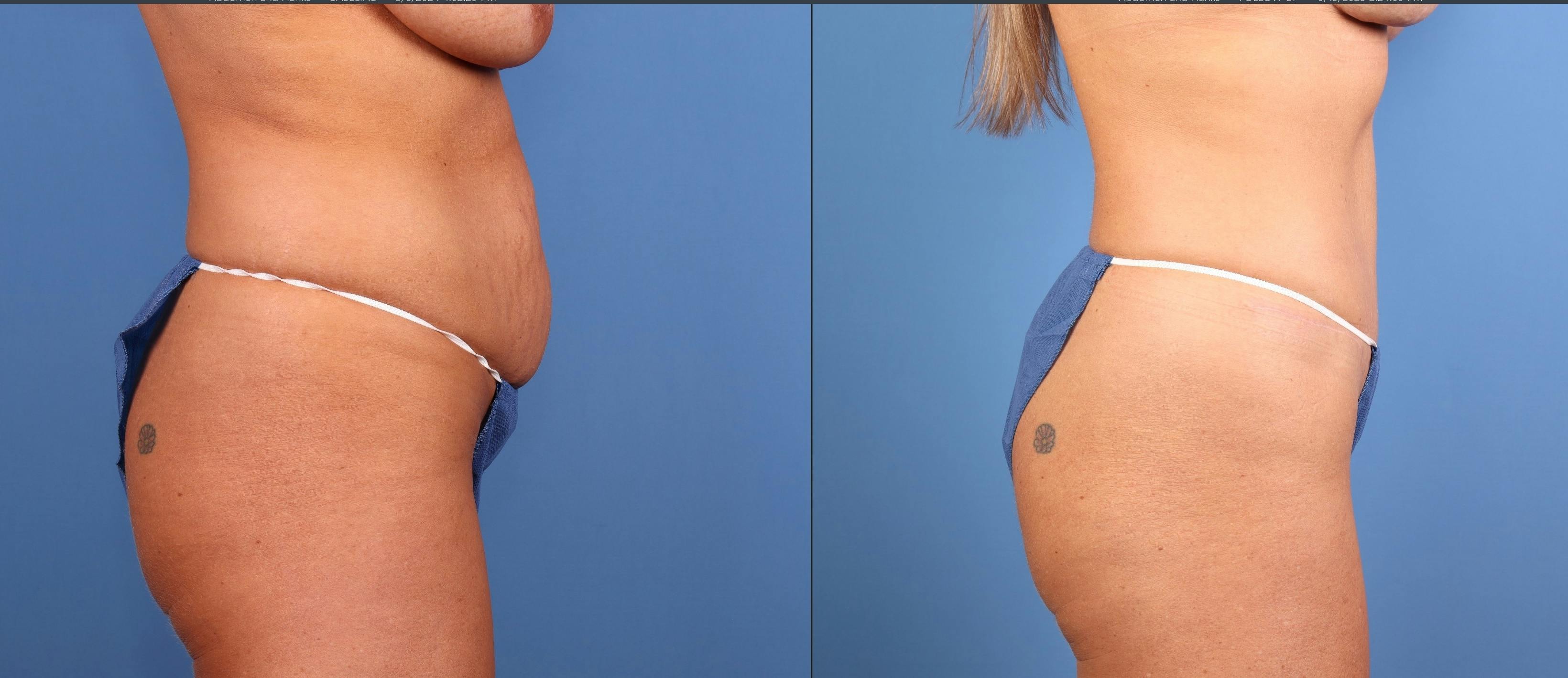 Tummy Tuck Before & After Gallery - Patient 317065 - Image 4
