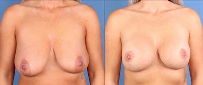 Breast Lift with Augmentation Before & After Gallery - Patient 301859 - Image 1