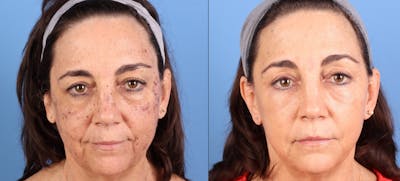Eyelid Surgery (Upper & Lower Blepharoplasty) Before & After Gallery - Patient 169802 - Image 1