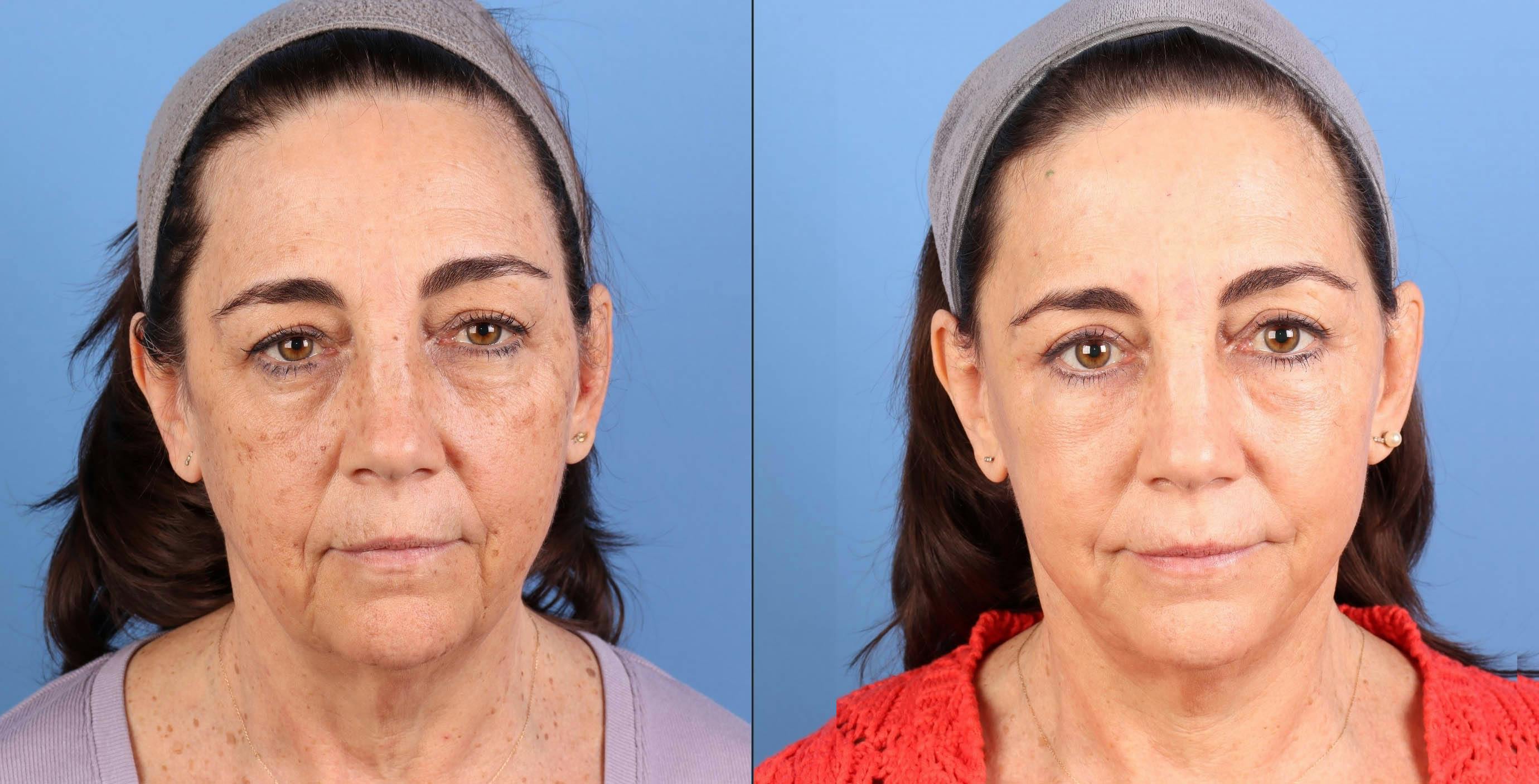 Broad Band Light (BBL) Before & After Gallery - Patient 192670 - Image 2