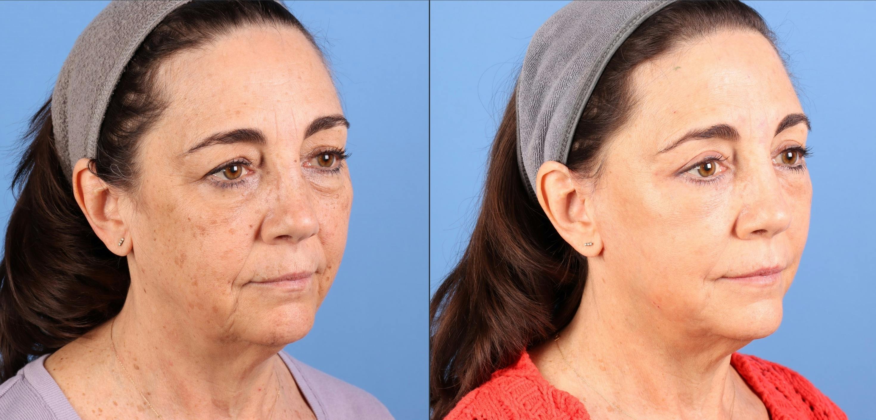 Broad Band Light (BBL) Before & After Gallery - Patient 192670 - Image 3