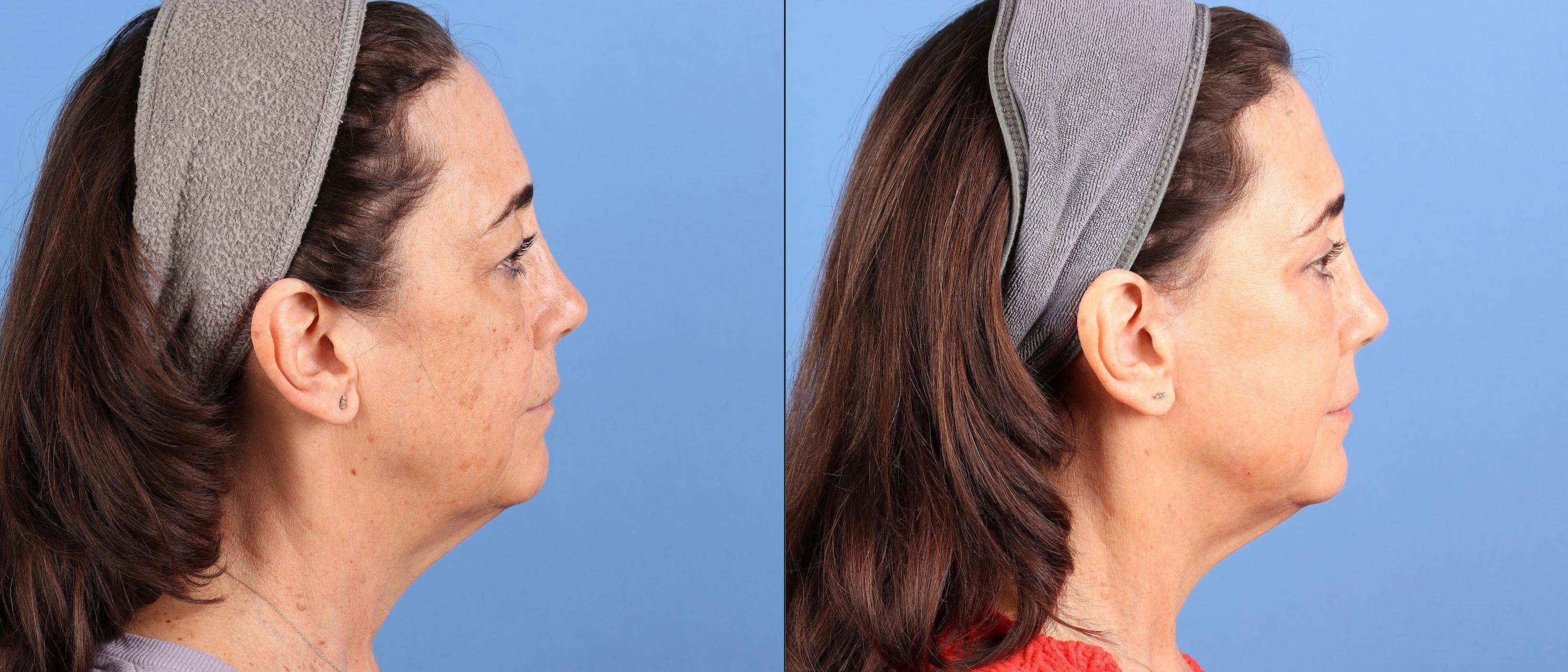 Broad Band Light (BBL) Before & After Gallery - Patient 192670 - Image 4