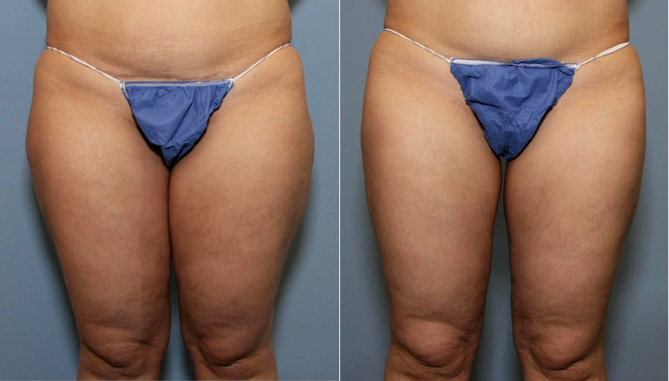 Hip Dip Correction Before & After Gallery - Patient 938838 - Image 1