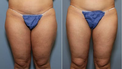 Hip Dip Correction Before & After Gallery - Patient 406692 - Image 1