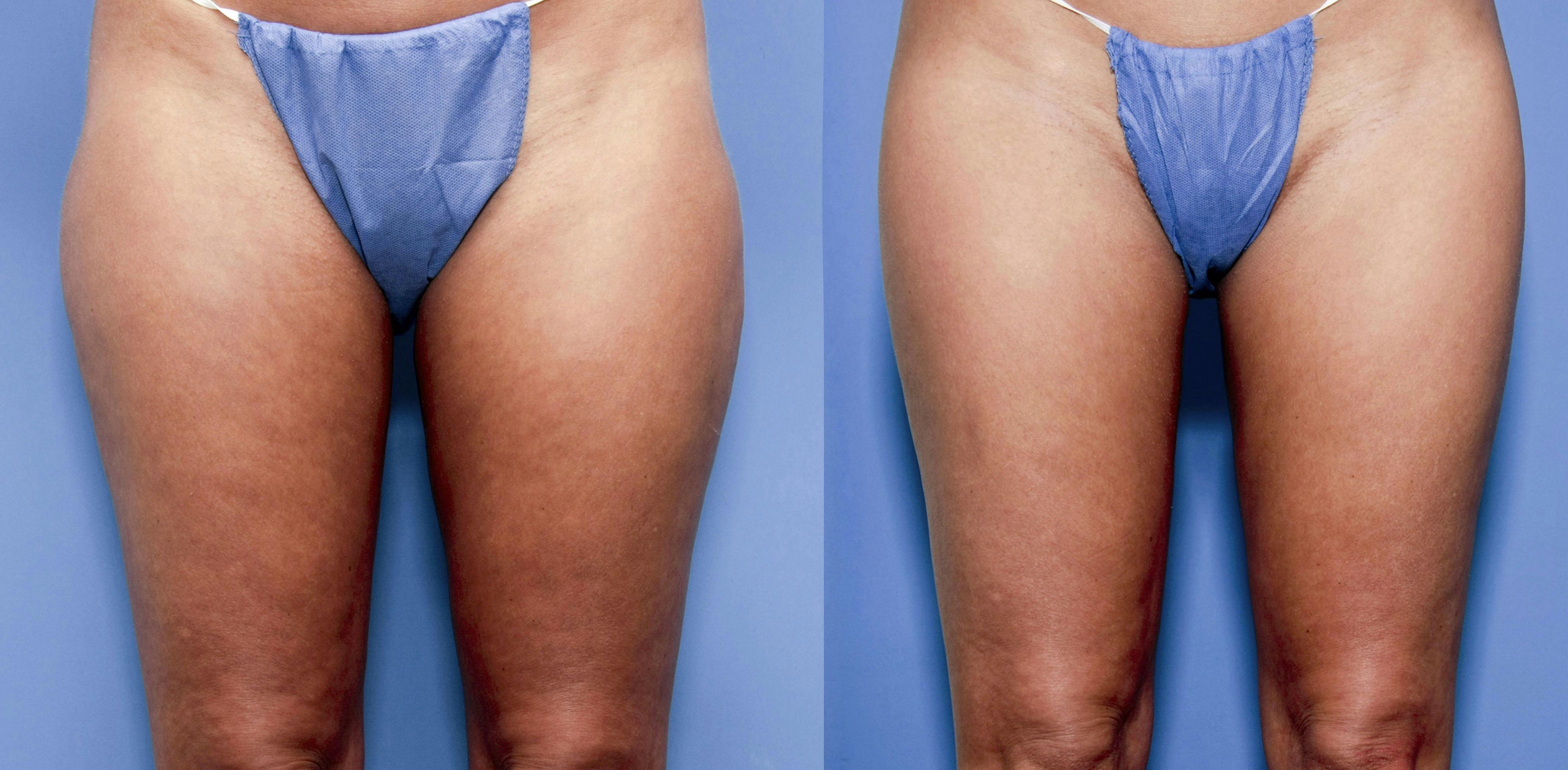 Hip Dip Correction Before & After Gallery - Patient 322219 - Image 1