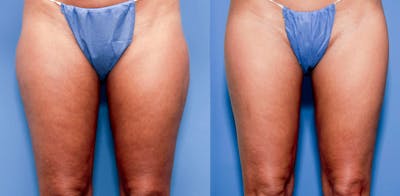 Hip Dip Correction Before & After Gallery - Patient 123761 - Image 1
