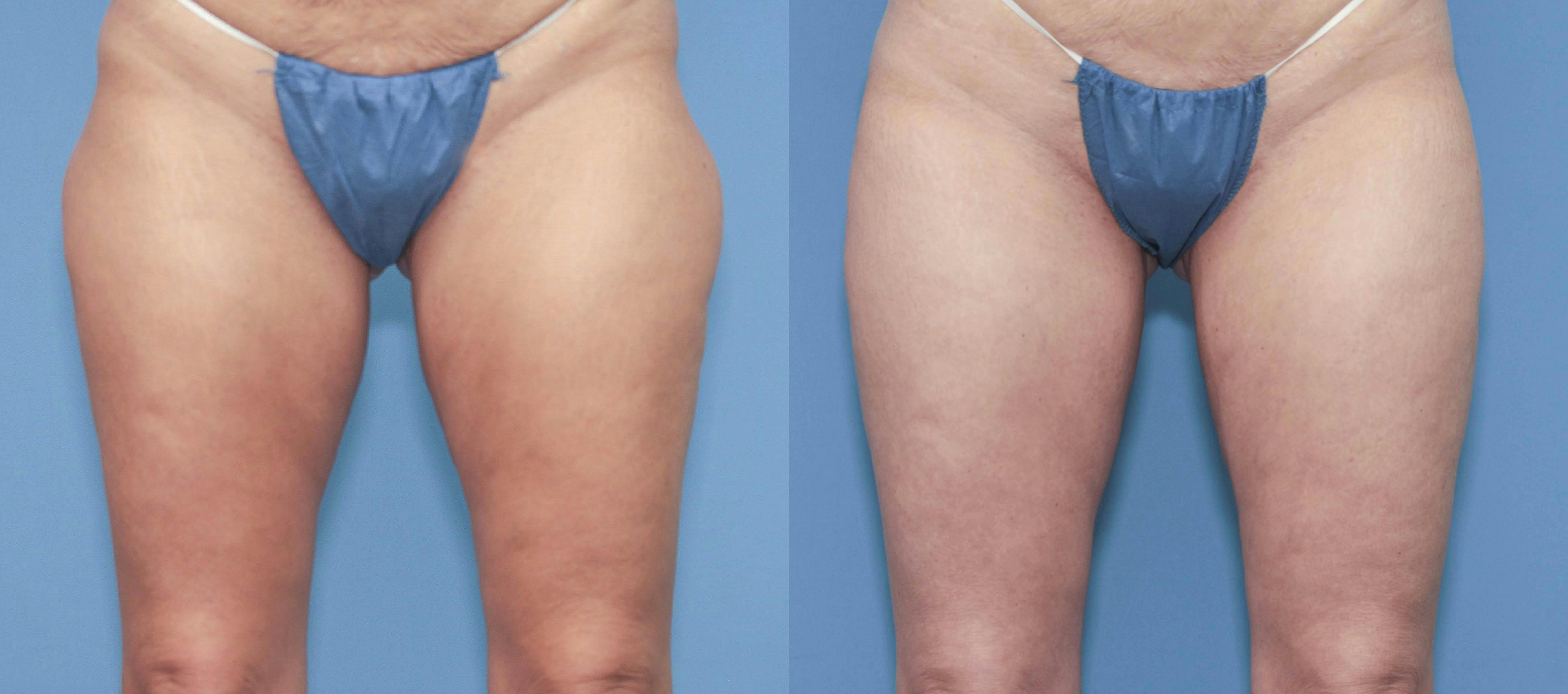 Hip Dip Correction Before & After Gallery - Patient 369571 - Image 1