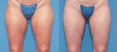 Hip Dip Correction Before & After Gallery - Patient 841848 - Image 1