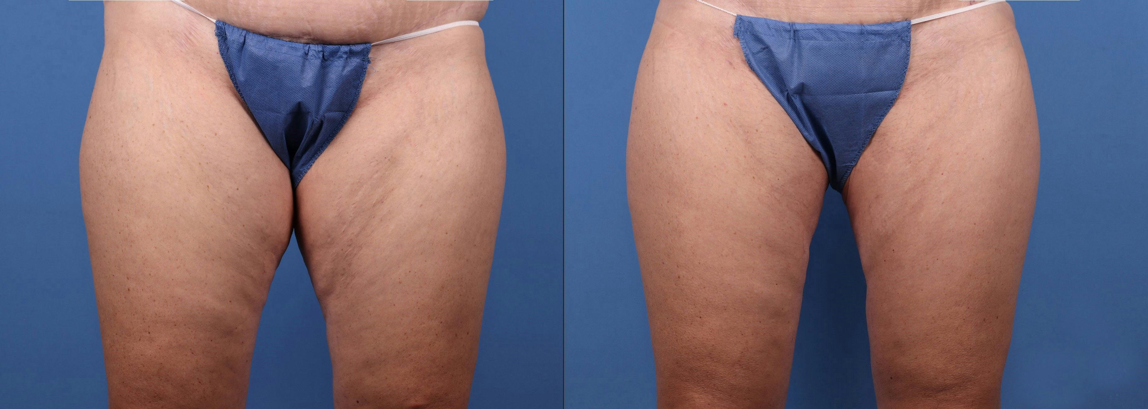 Hip Dip Correction Before & After Gallery - Patient 385593 - Image 1