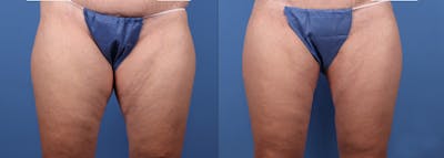 Hip Dip Correction Before & After Gallery - Patient 114456 - Image 1