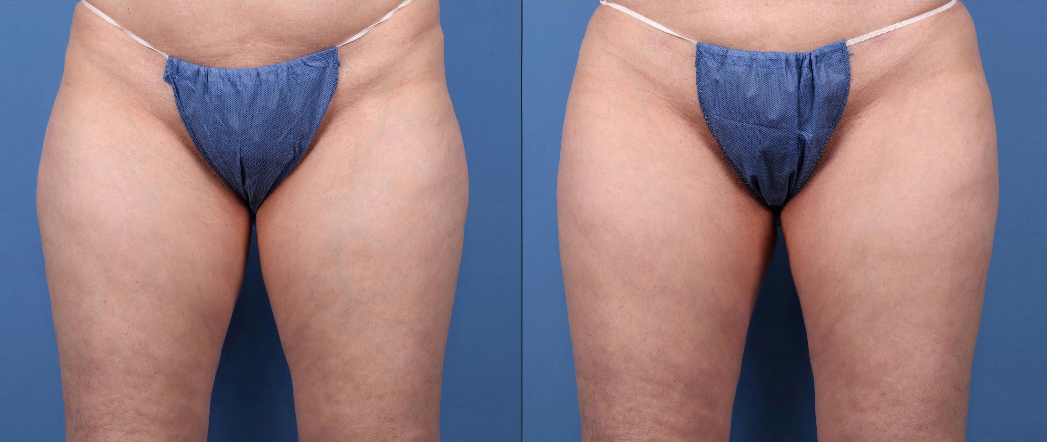 Hip Dip Correction Before & After Gallery - Patient 154511 - Image 1