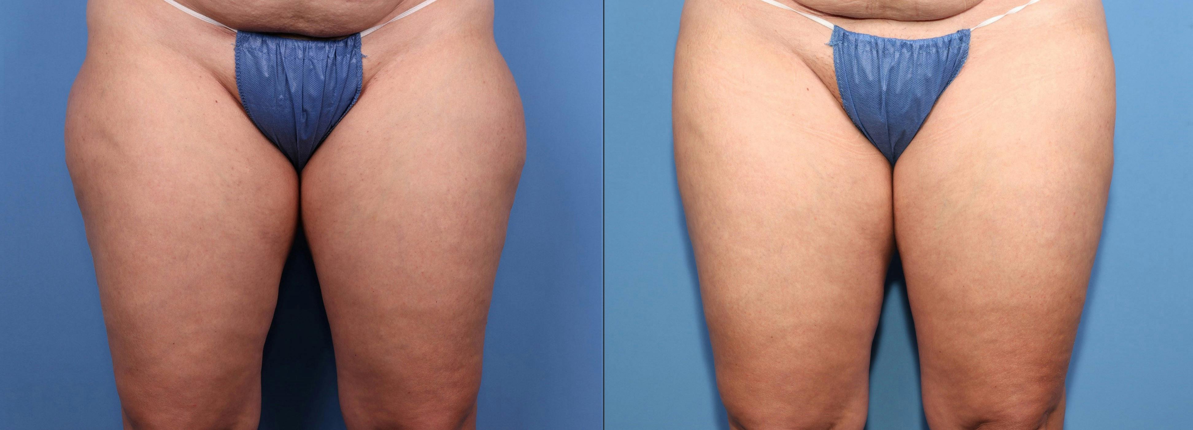 Hip Dip Correction Before & After Gallery - Patient 180099 - Image 1