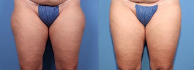 Hip Dip Correction Before & After Gallery - Patient 424476 - Image 1