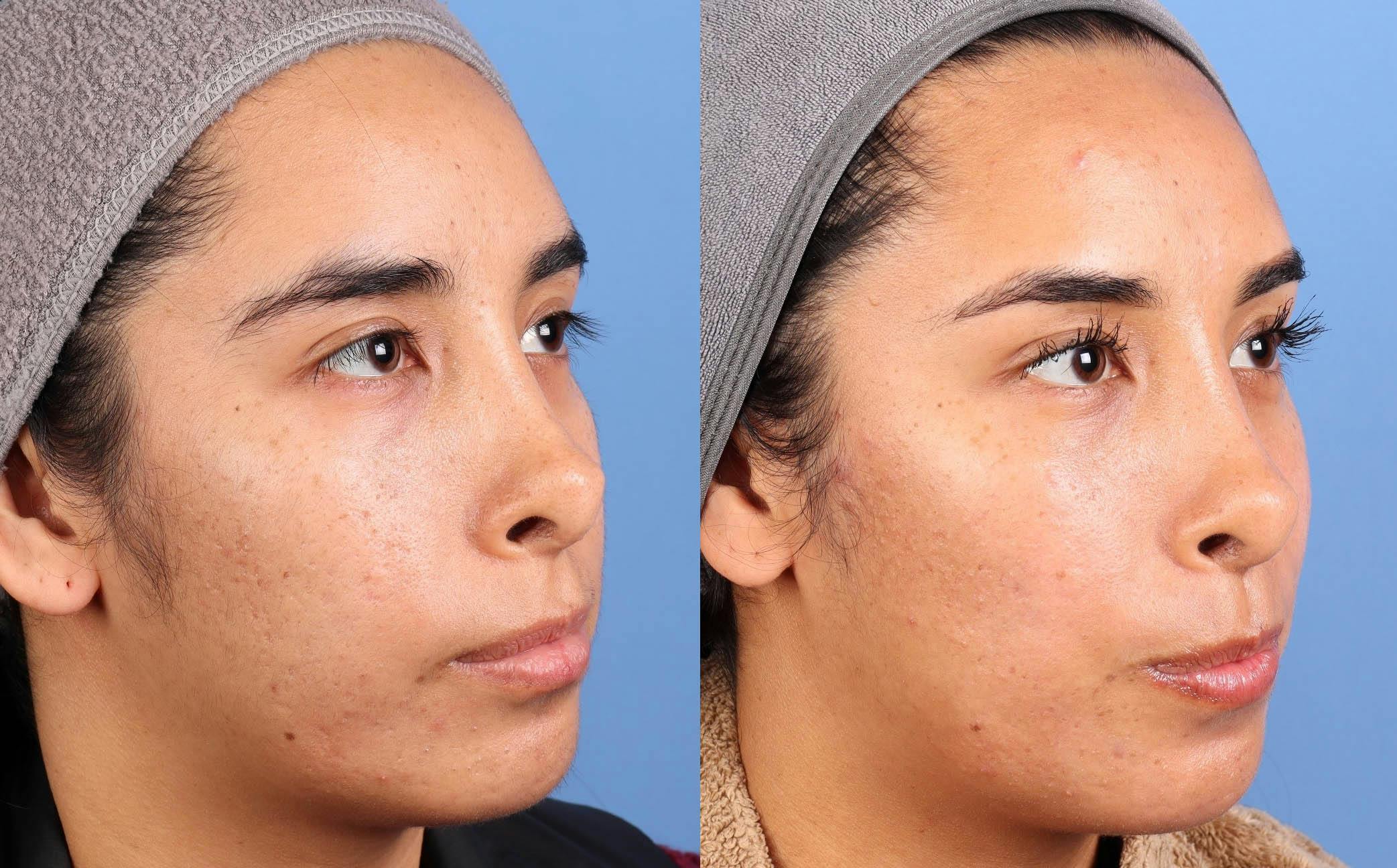 Contour TRL Laser Before & After Gallery - Patient 171859 - Image 1