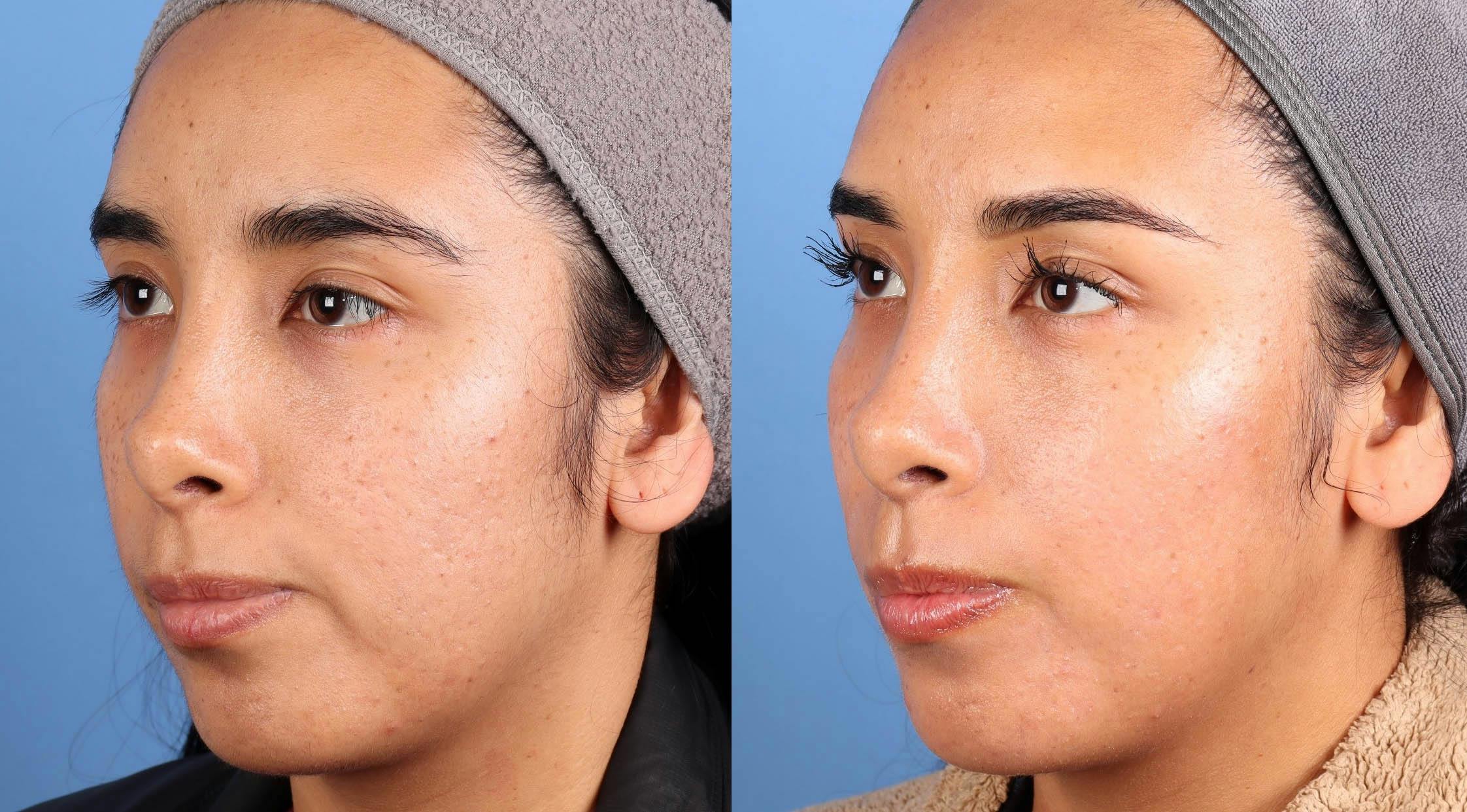 Contour TRL Laser Before & After Gallery - Patient 171859 - Image 2