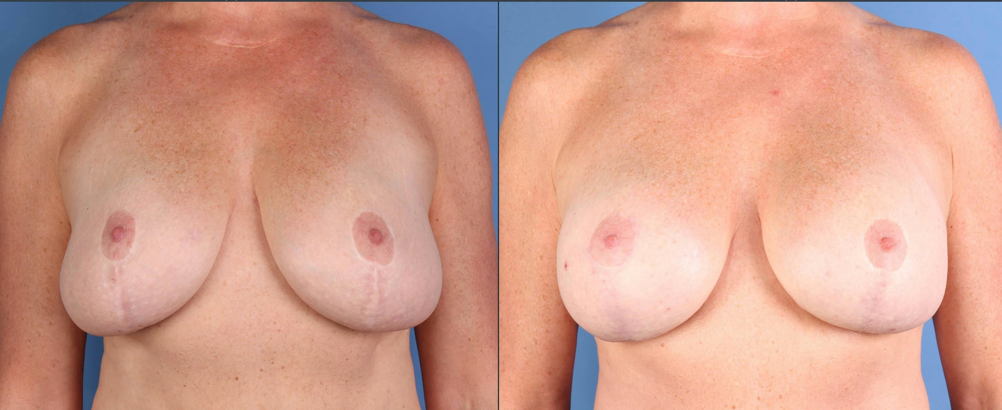 Breast Lift Before & After Gallery - Patient 171077 - Image 1