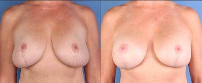 Breast Lift with Augmentation Before & After Gallery - Patient 133185 - Image 1
