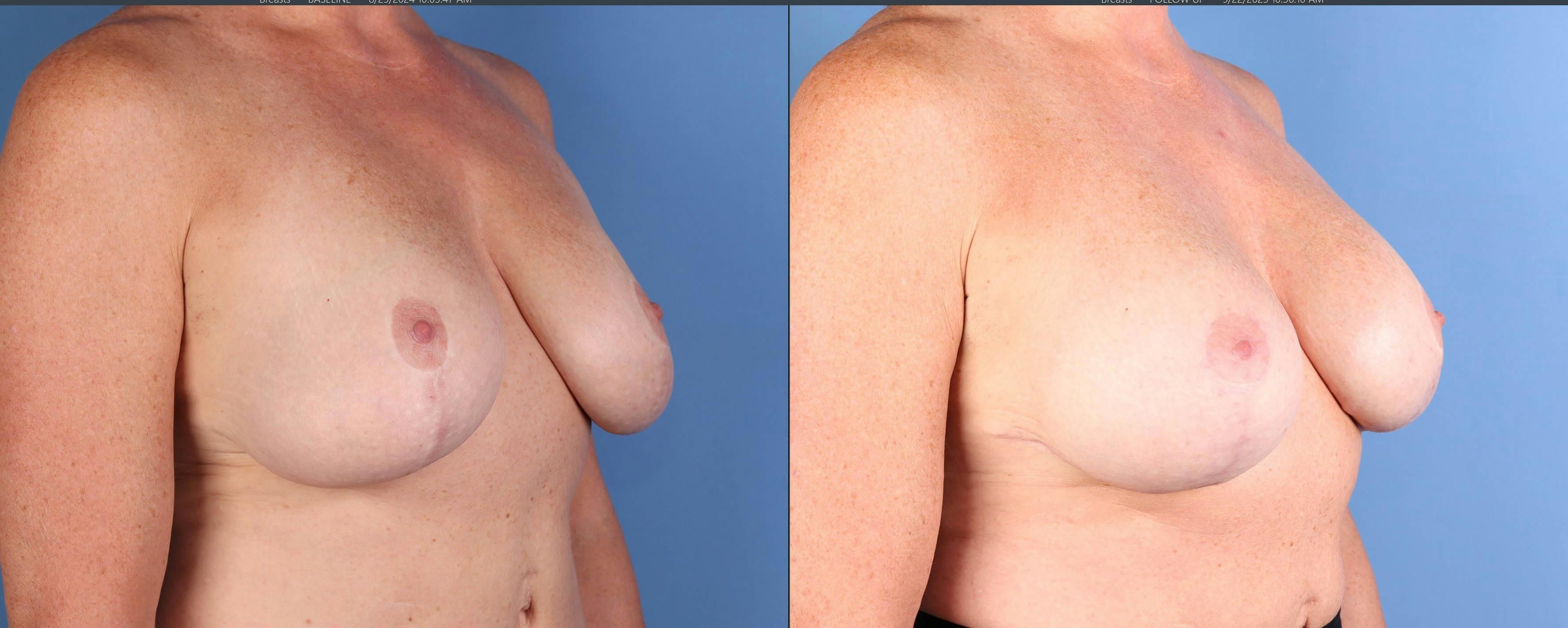 Breast Lift Before & After Gallery - Patient 171077 - Image 2
