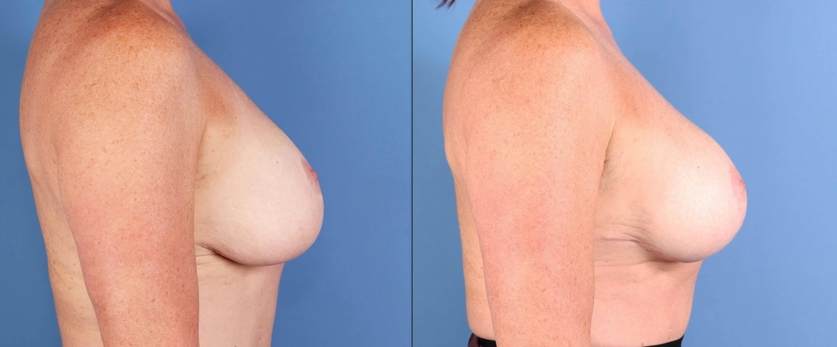 Breast Lift Before & After Gallery - Patient 171077 - Image 3