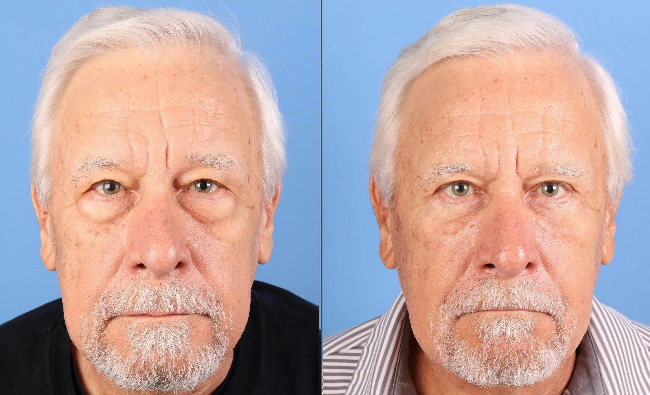 Eyelid Surgery (Lower Blepharoplasty) Before & After Gallery - Patient 392756 - Image 1
