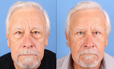 Eyelid Surgery (Upper & Lower Blepharoplasty) Before & After Gallery - Patient 871520 - Image 1