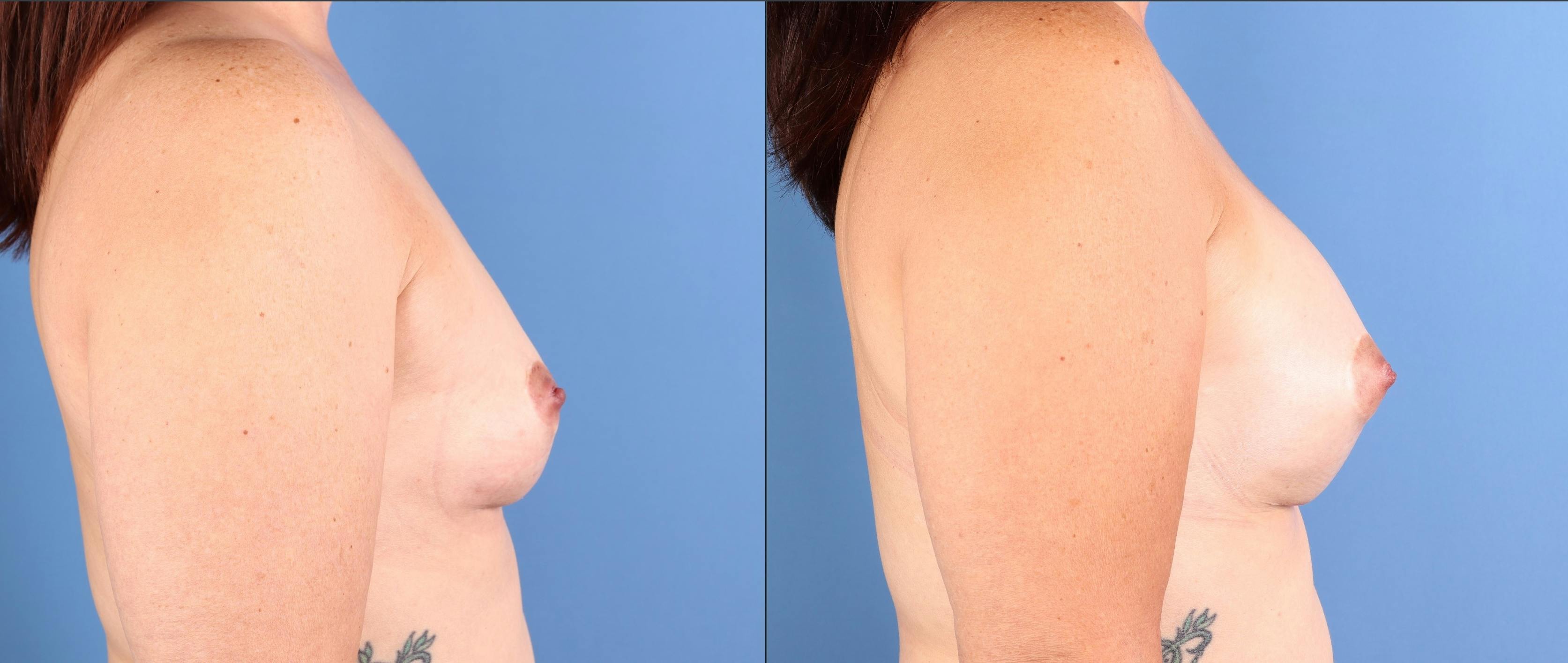 Breast Augmentation Before & After Gallery - Patient 152116 - Image 3