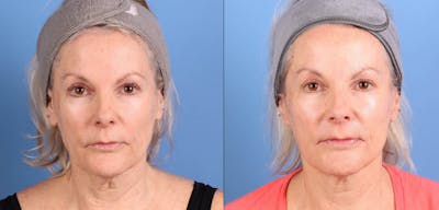 Contour TRL Laser Before & After Gallery - Patient 787914 - Image 1