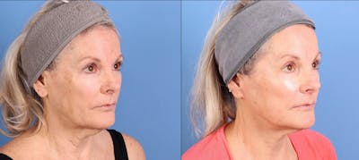 Laser Treatments Before & After Gallery - Patient 246763 - Image 1