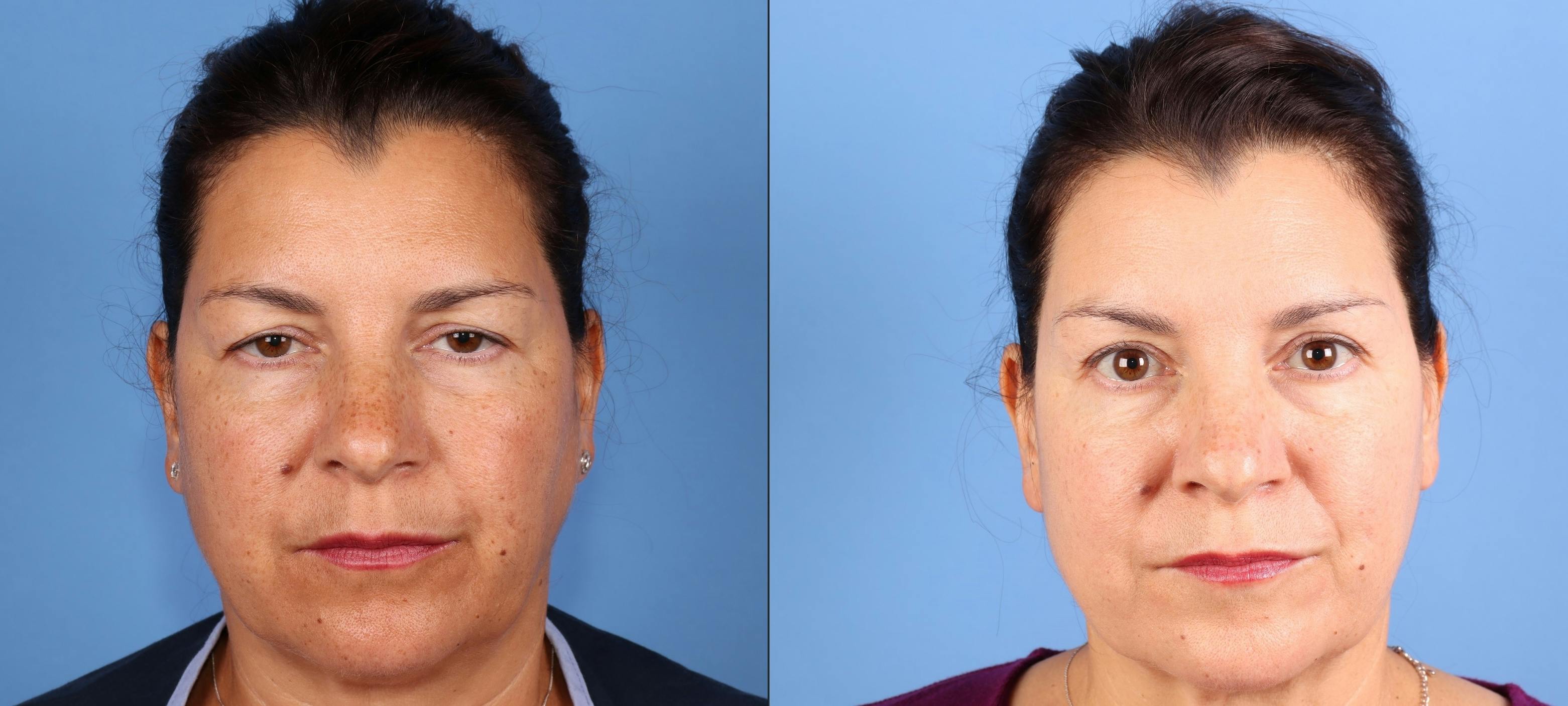 Eyelid Surgery (Upper Blepharoplasty) Before & After Gallery - Patient 295585 - Image 1