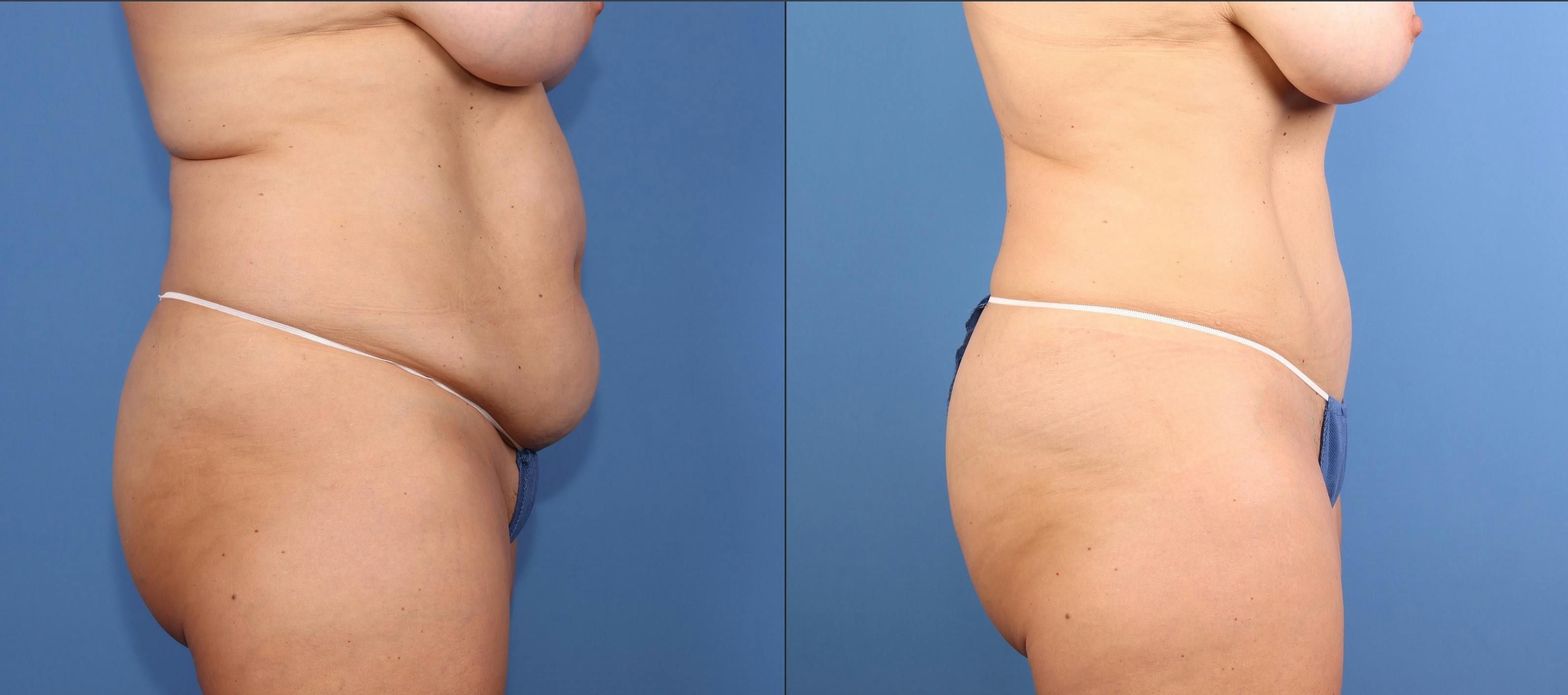 Abdomen Before & After Gallery - Patient 396330 - Image 5