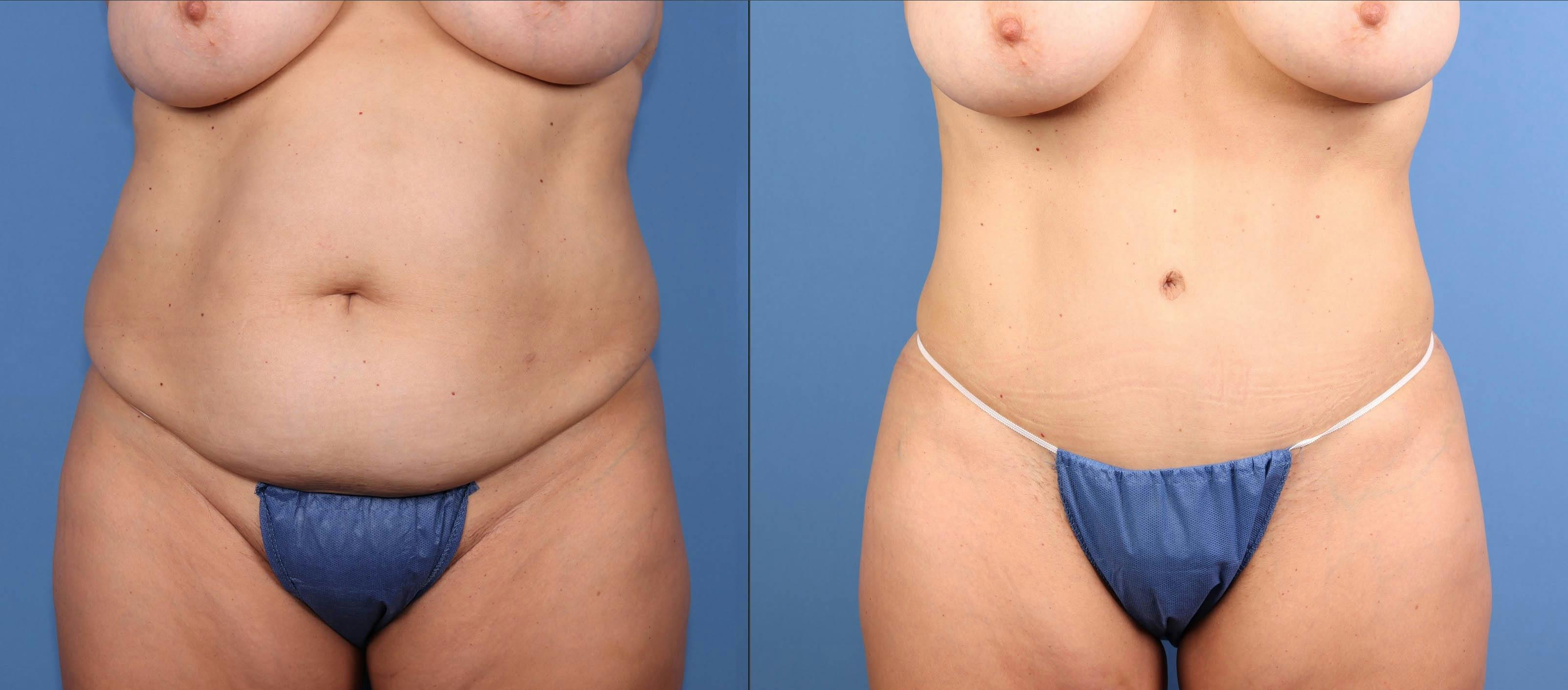 Abdomen Before & After Gallery - Patient 396330 - Image 1