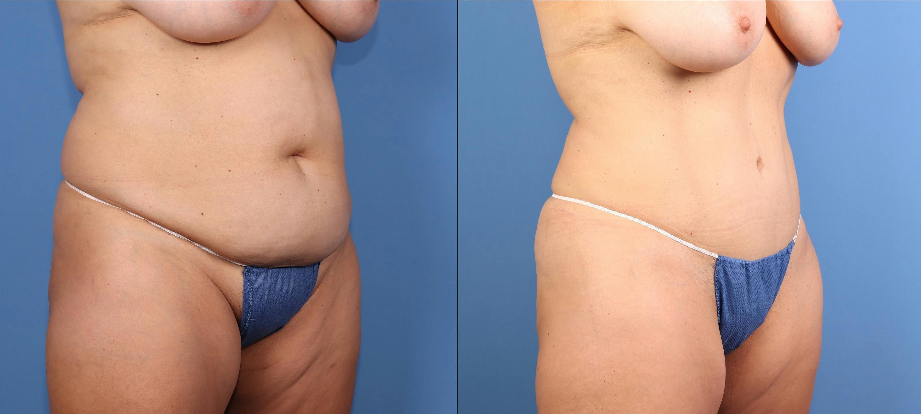 Abdomen Before & After Gallery - Patient 396330 - Image 4