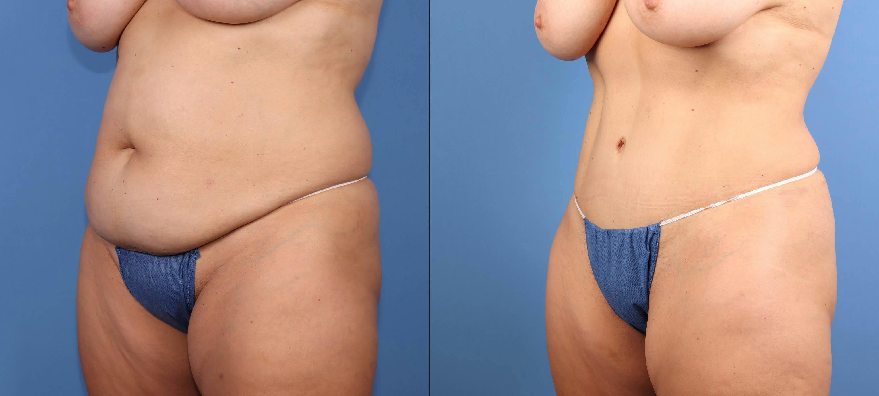 Abdomen Before & After Gallery - Patient 396330 - Image 2