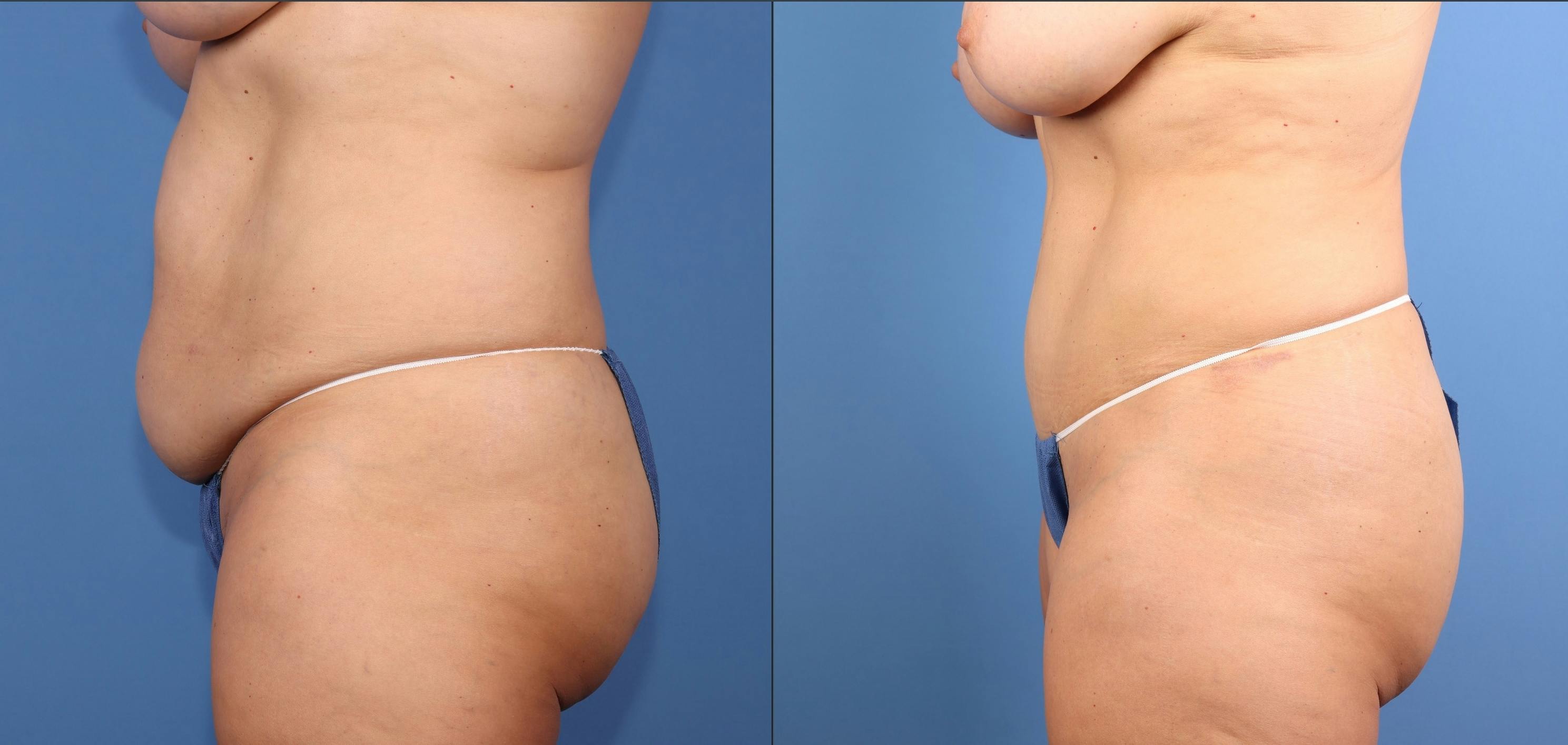 Abdomen Before & After Gallery - Patient 396330 - Image 3