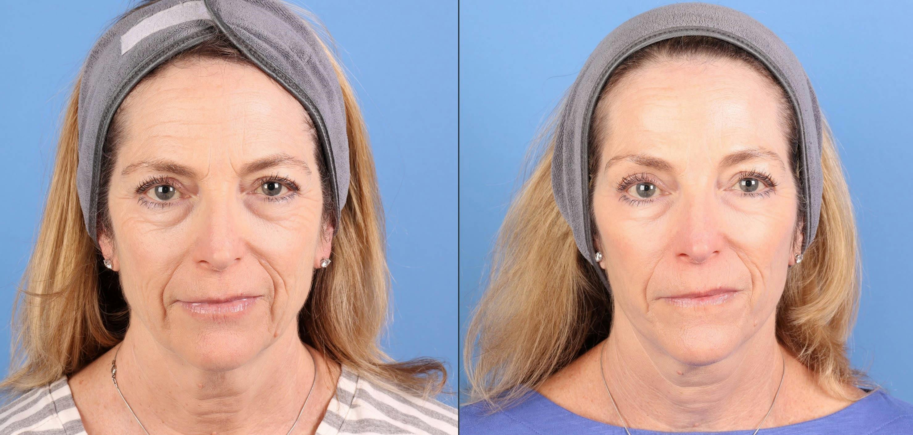 Face Lift Before & After Gallery - Patient 645152 - Image 2