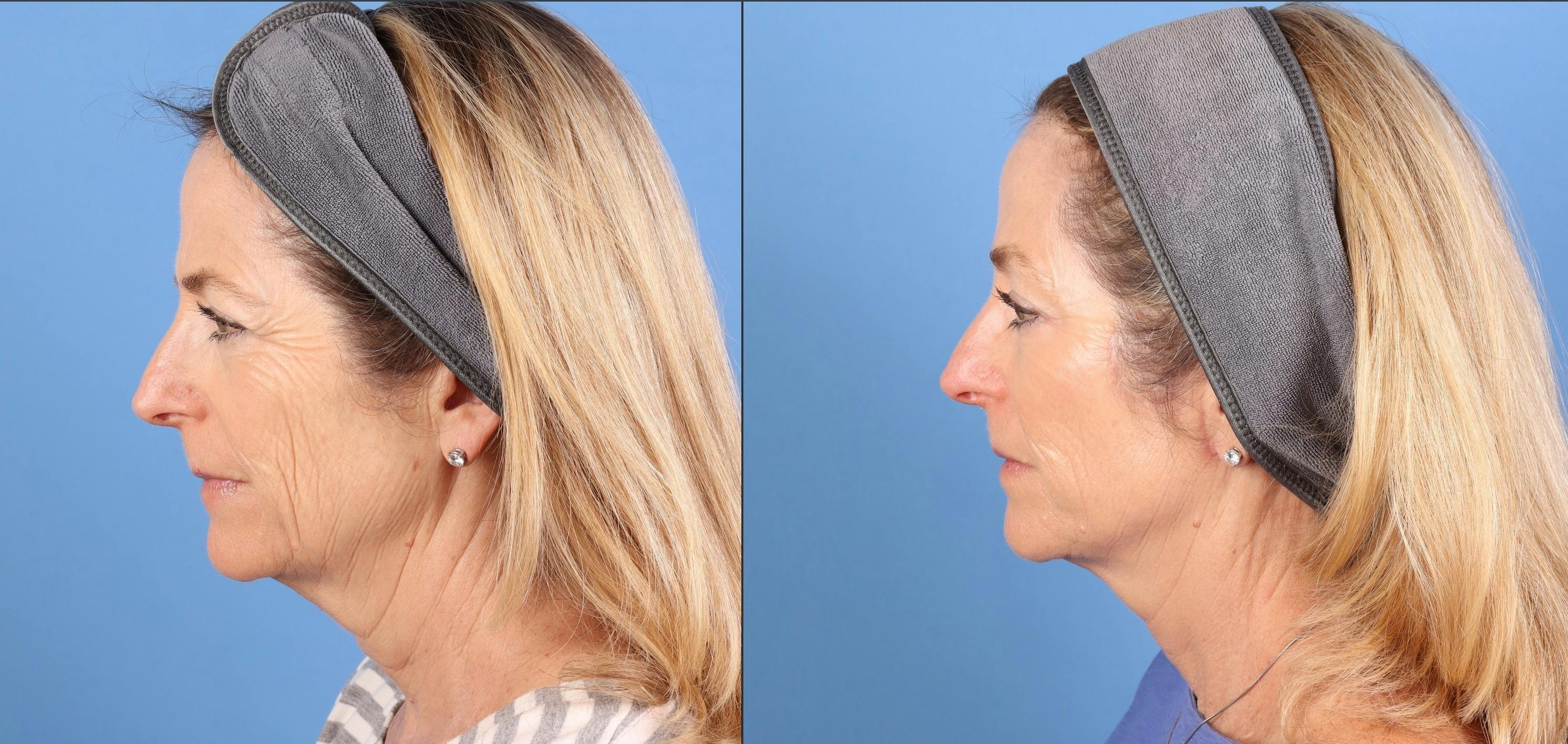 Face Lift Before & After Gallery - Patient 645152 - Image 5