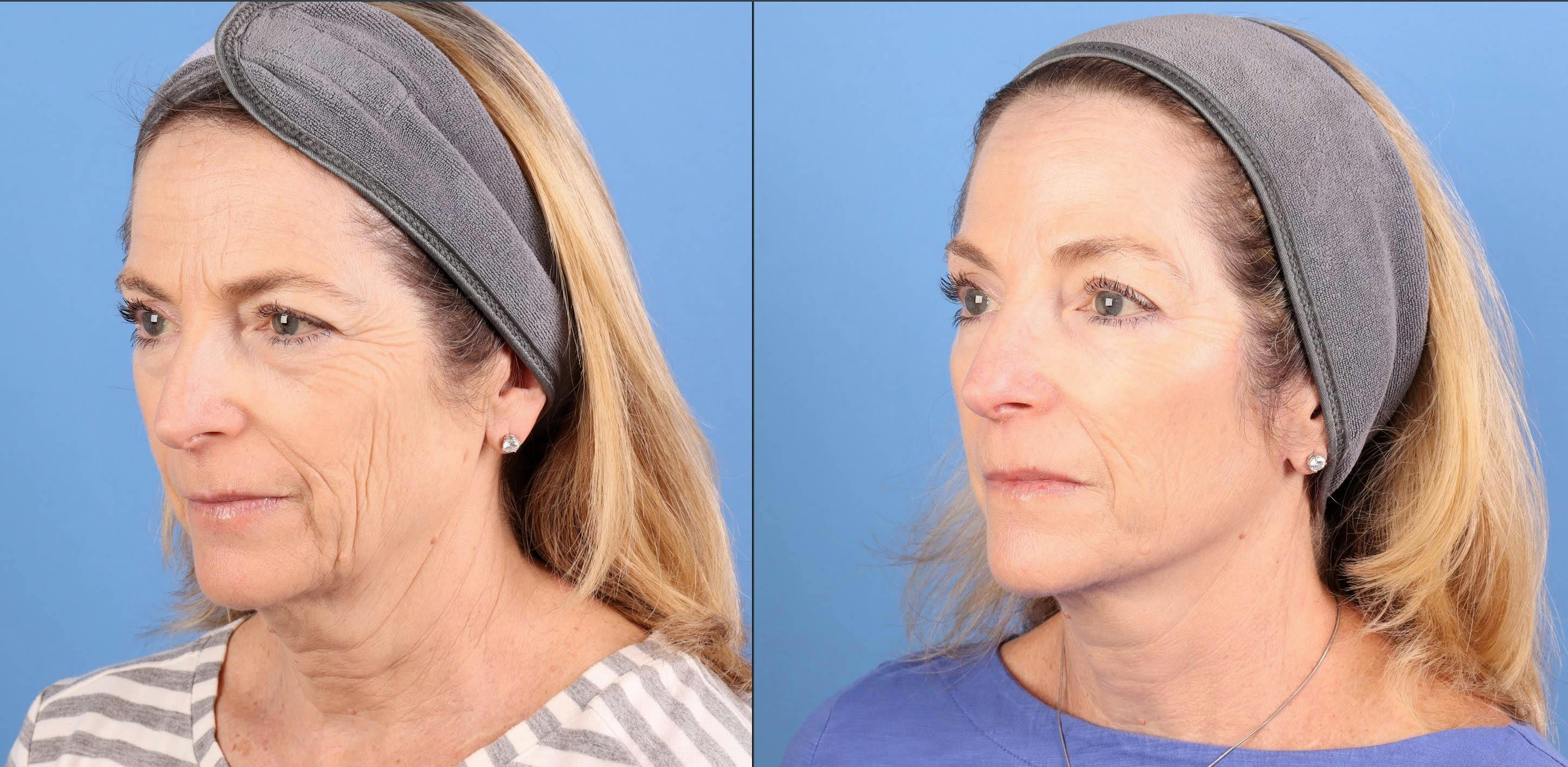 Face Lift Before & After Gallery - Patient 645152 - Image 1