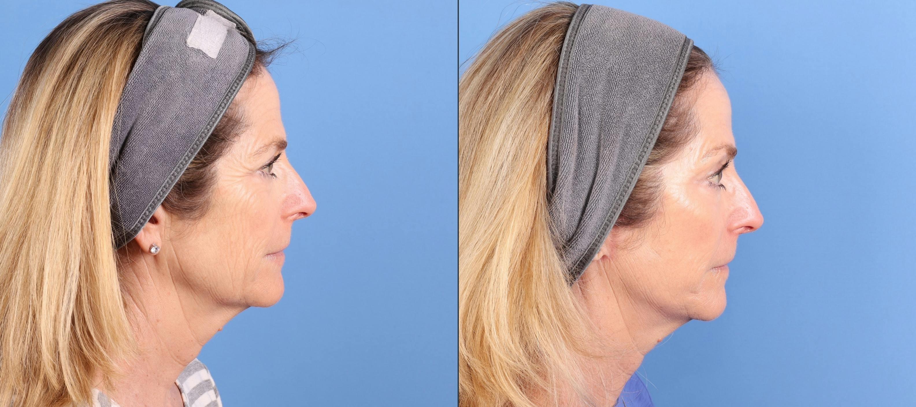 Face Lift Before & After Gallery - Patient 645152 - Image 4