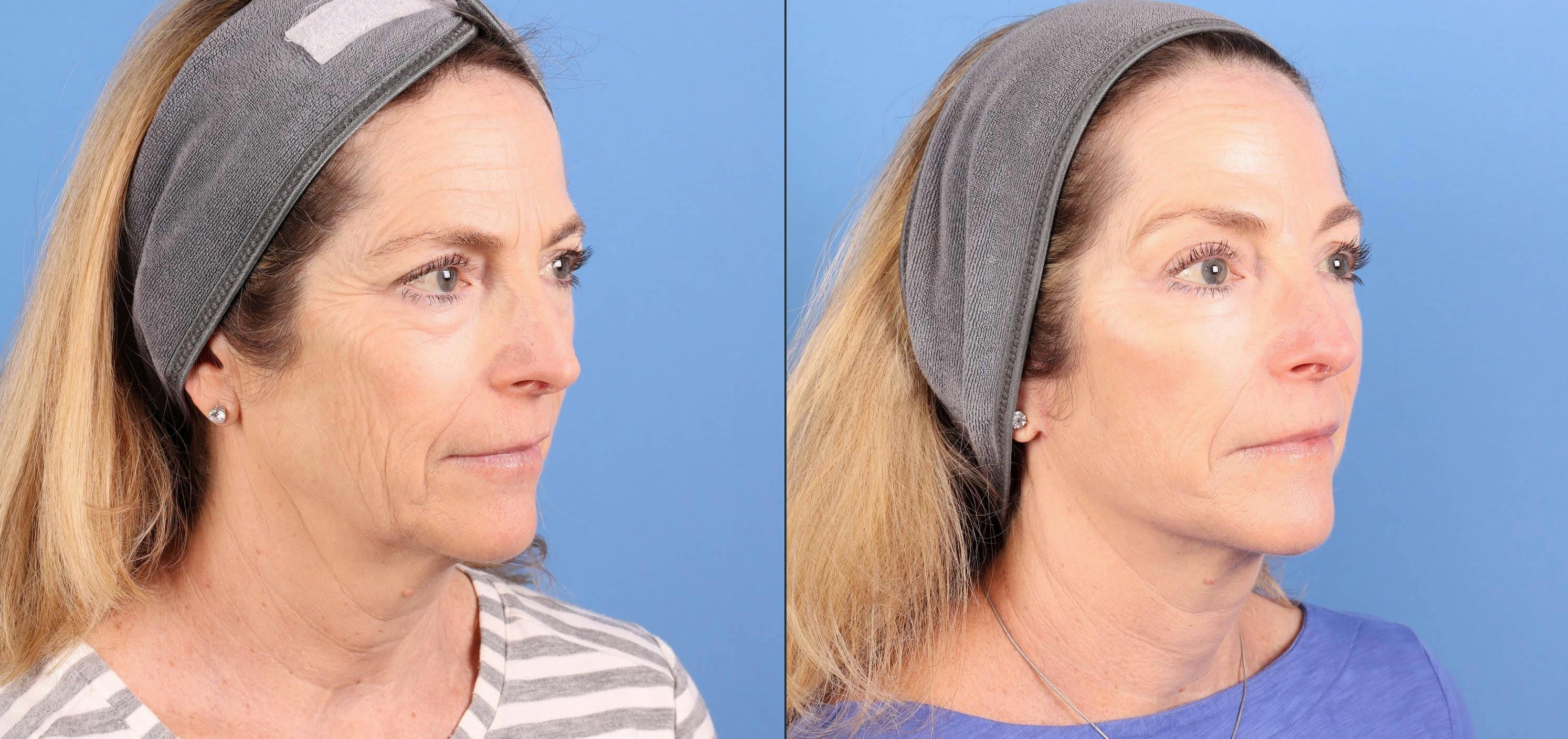 Face Lift Before & After Gallery - Patient 645152 - Image 3