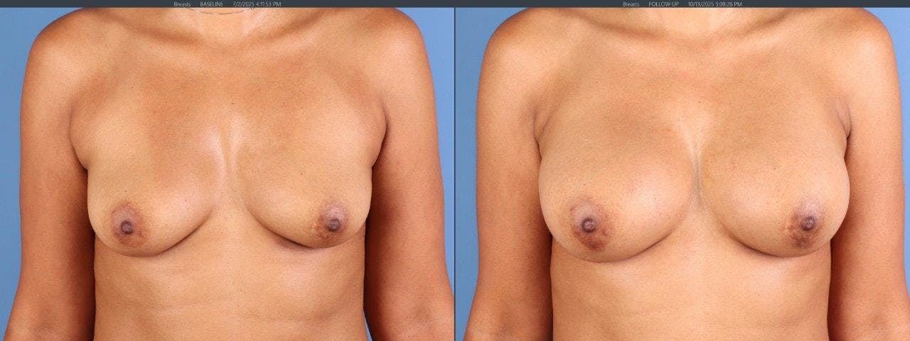 Fat Transfer Breast Augmentation Before & After Gallery - Patient 397777 - Image 1