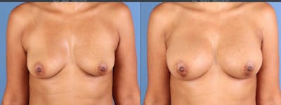 Fat Transfer Breast Augmentation Before & After Gallery - Patient 397777 - Image 1