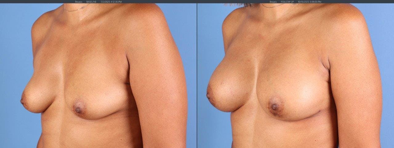 Fat Transfer Breast Augmentation Before & After Gallery - Patient 397777 - Image 2