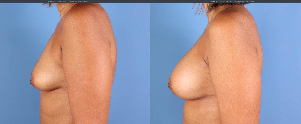Fat Transfer Breast Augmentation Before & After Gallery - Patient 397777 - Image 3